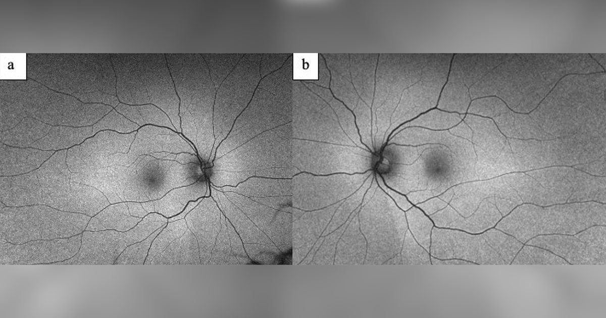 Fundus autofluorescence