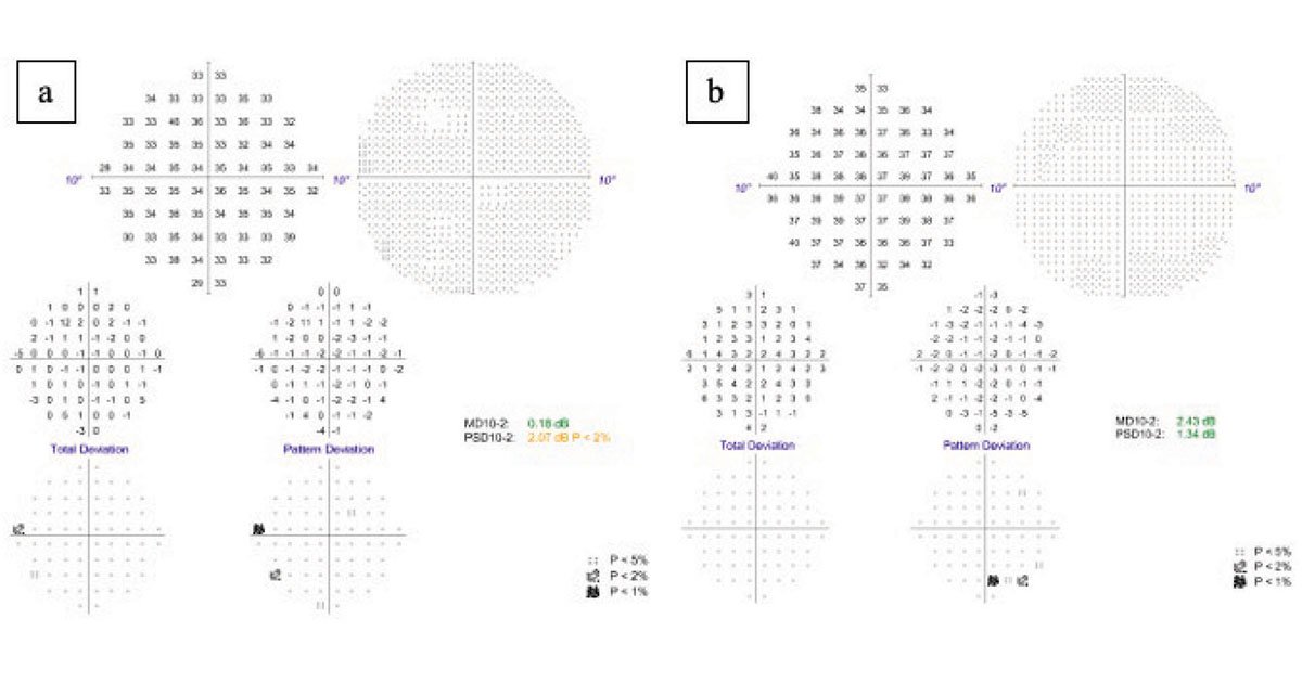 Humphrey visual field 10-2 images