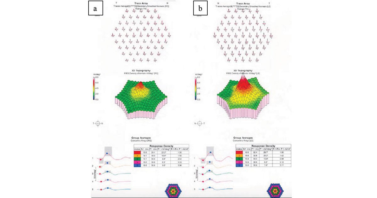 mfERG showing slightly reduced retinal response