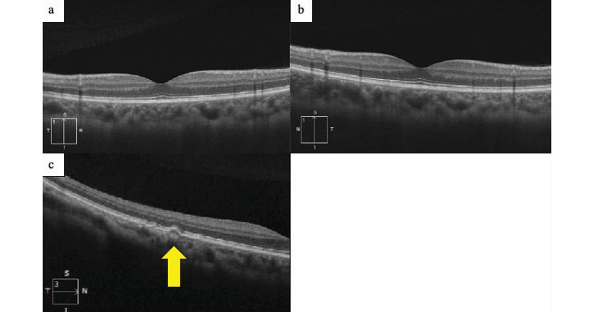 OCT macula