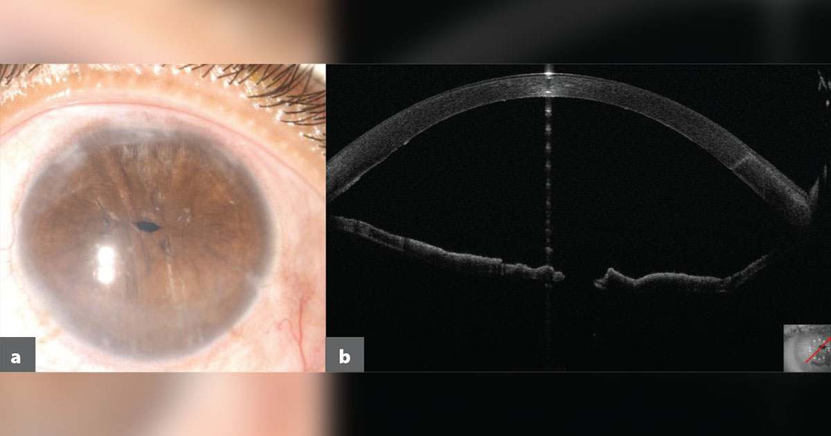 Pinhole pupilloplasty in an eye with higher-order corneal aberrations