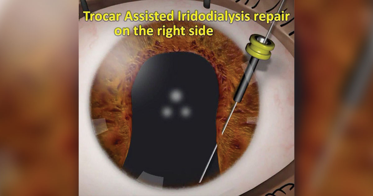 Trocar-assisted repair