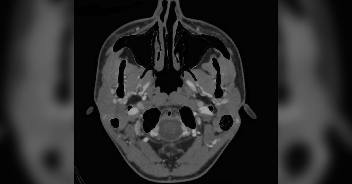 CTA image of the head and neck