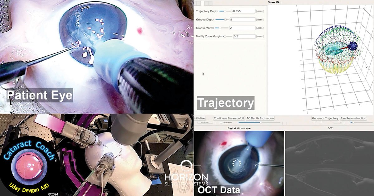 The robot uses high-definition 3D cameras as well as OCT imaging