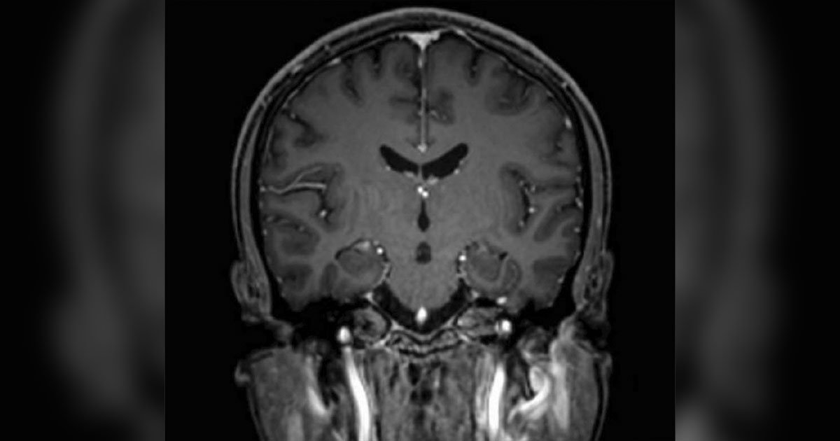 MRI of the head.