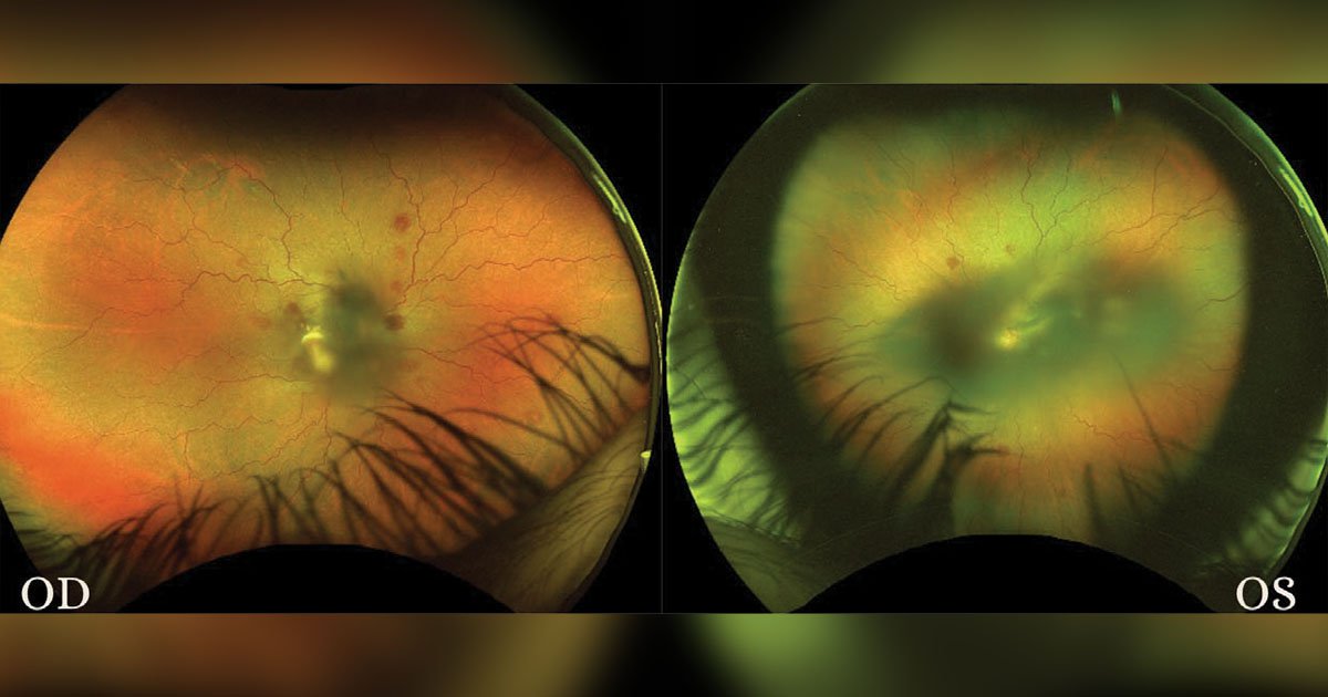 Optos fundus photos of the right eye and left eye at day 14 of inpatient admission