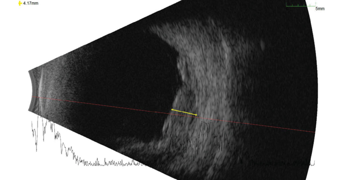 ultrasonography of the right eye lesion