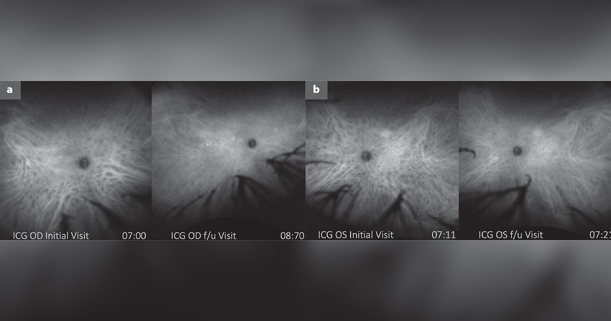 Comparison of ICG angiography at initial and last follow-up visits