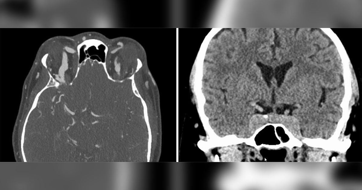 CT and CTA of the head showed enlargement of both superior ophthalmic veins and bulging of the cavernous sinuses