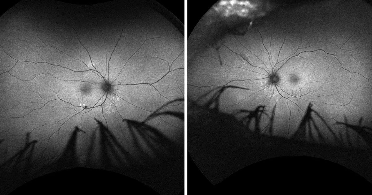 Fundus autofluorescence demonstrating nasal and superior chorioretinal lesions