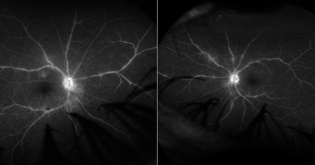 Late-phase FA of the right and left eyes demonstrating phlebitis