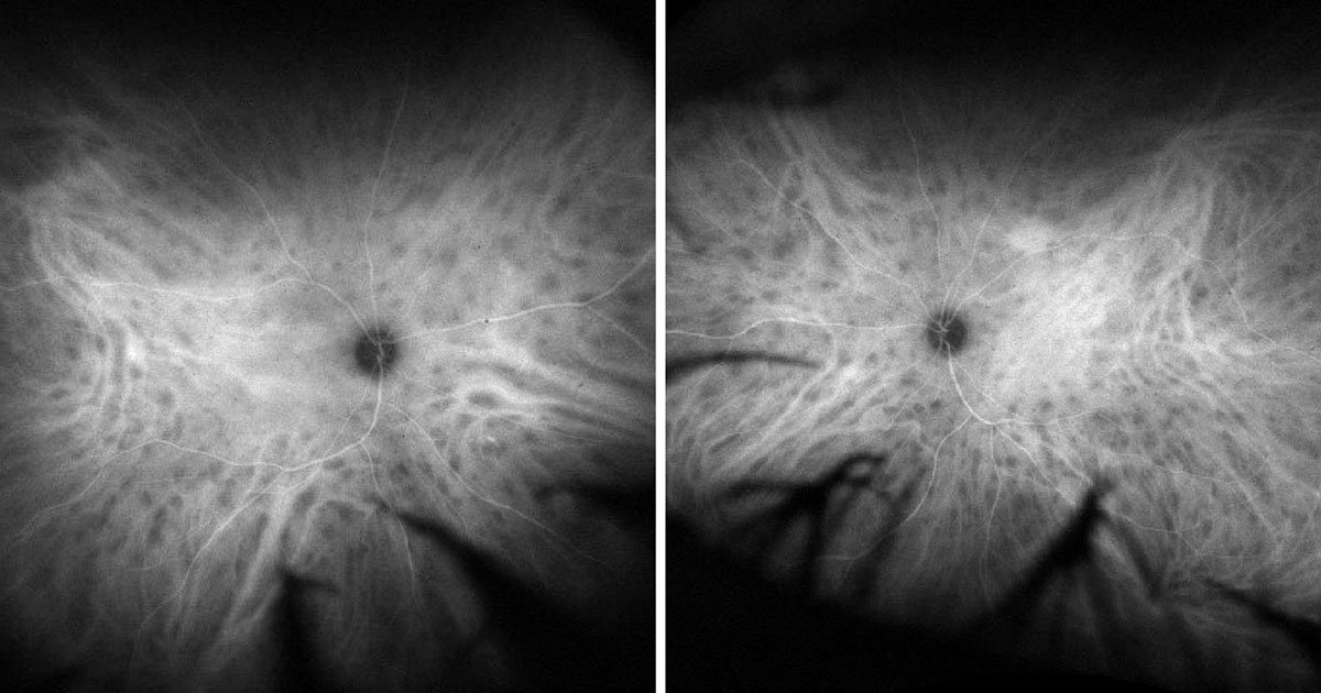 Late-phase ICG angiography demonstrating scattered hypocyanescent spots bilaterally