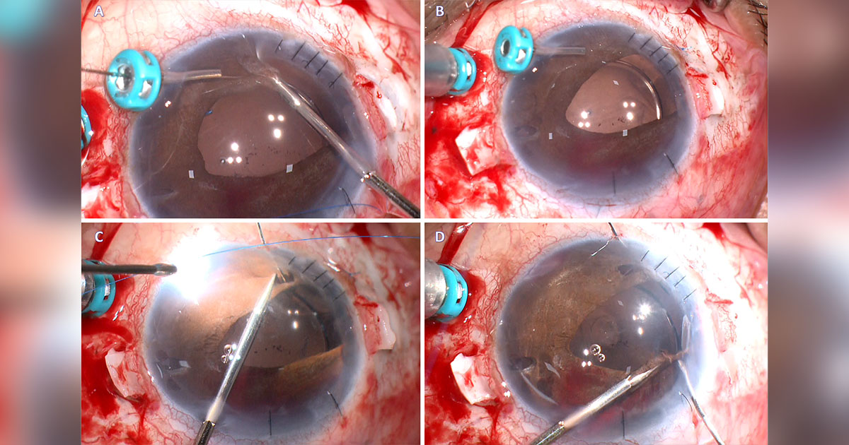 The trocar-assisted iris repair technique