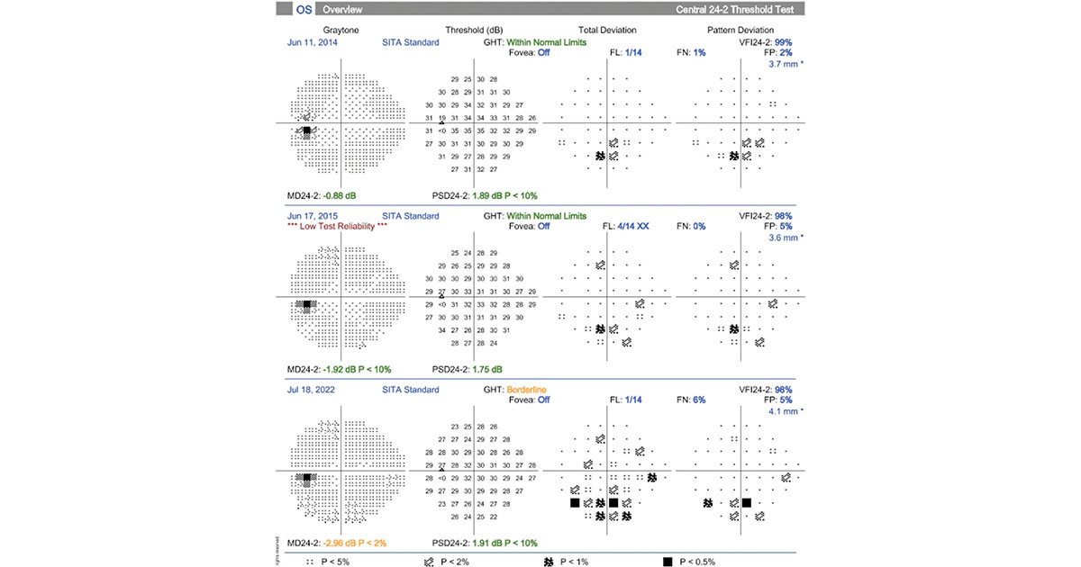 Humphrey visual fields of the left eye comparing current presentation to prior visits