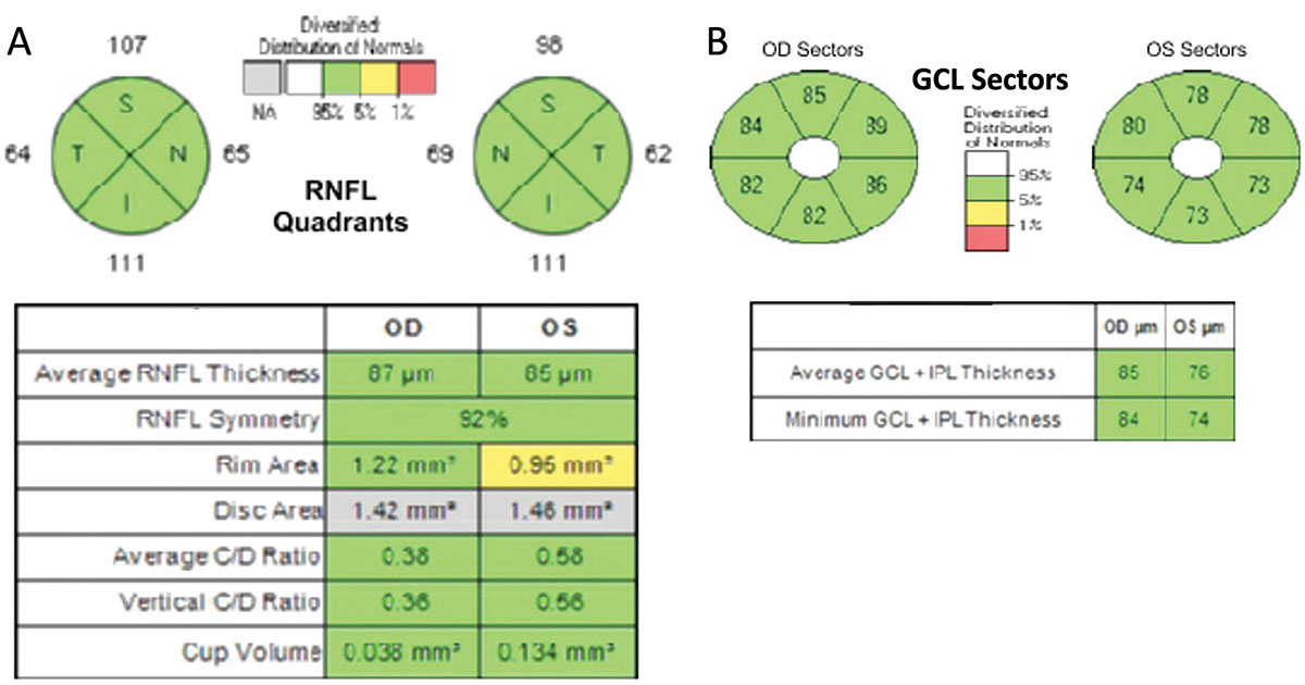 OCT of the retinal nerve fiber layer and ganglion cell layer of both eyes at time of current presentation