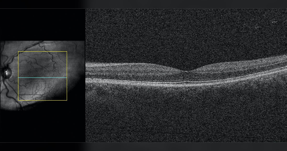 Left eye OCT scan of the macula and corresponding en face image