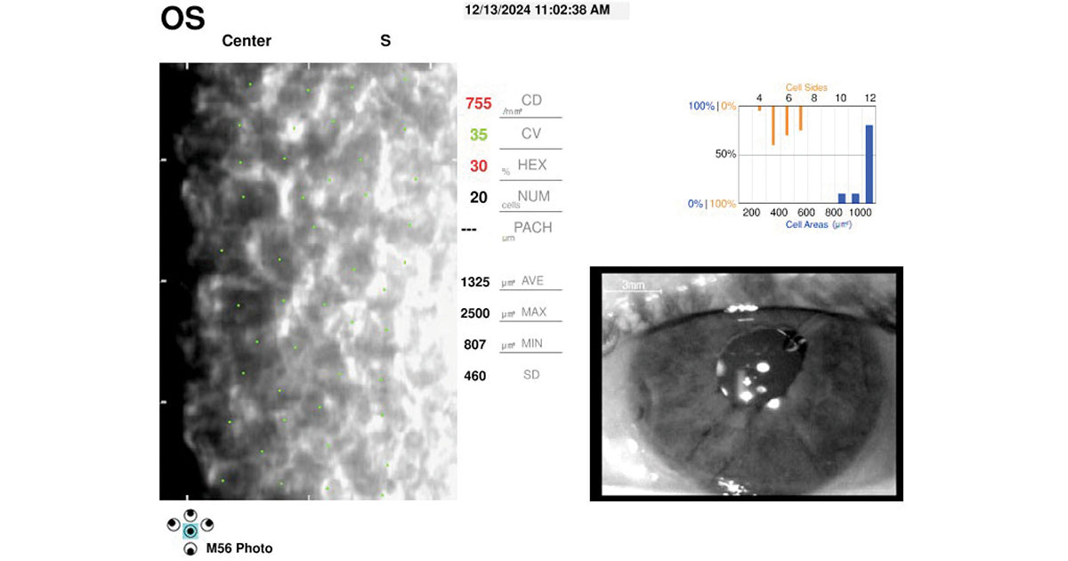 Specular microscopy of the left corneal endothelium